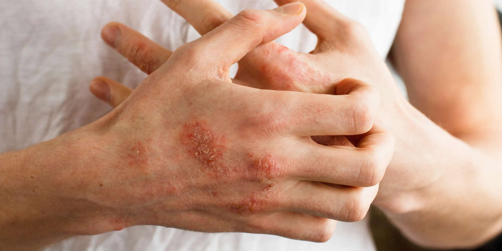 علائم حساسیت به سیب چیست؟